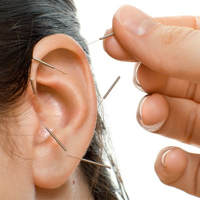 Acupuncture